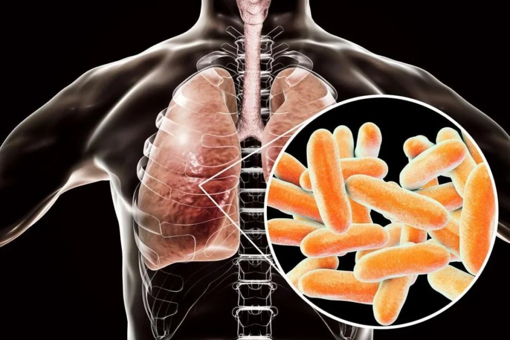 New York Grapples With Growing Legionnaires’ Disease Outbreak on Upper East Side